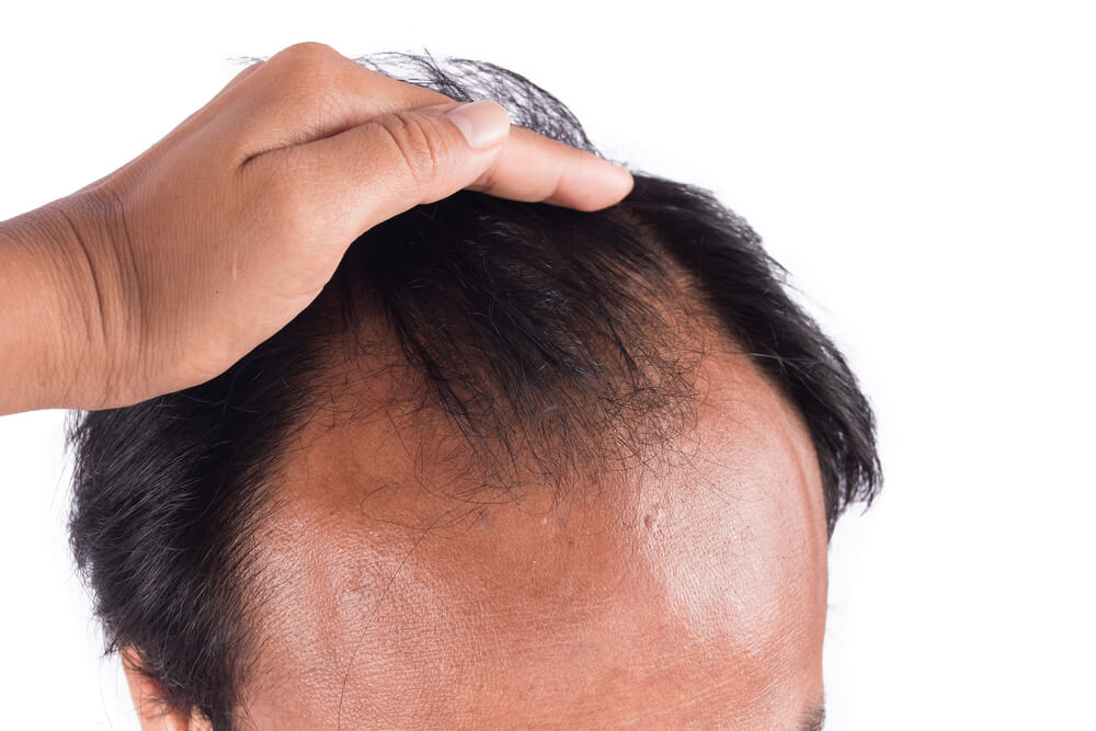 Hair Loss Treatment