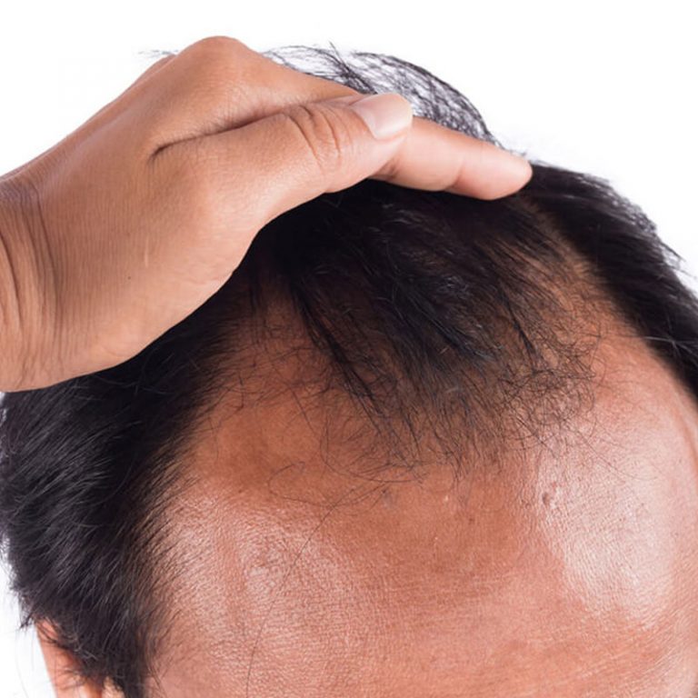 Hair loss Treatment