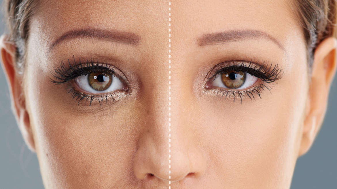 Ultherapy