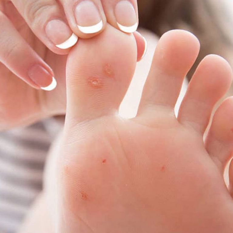 Callus Removal Singapore  Foot Corn Removal Singapore